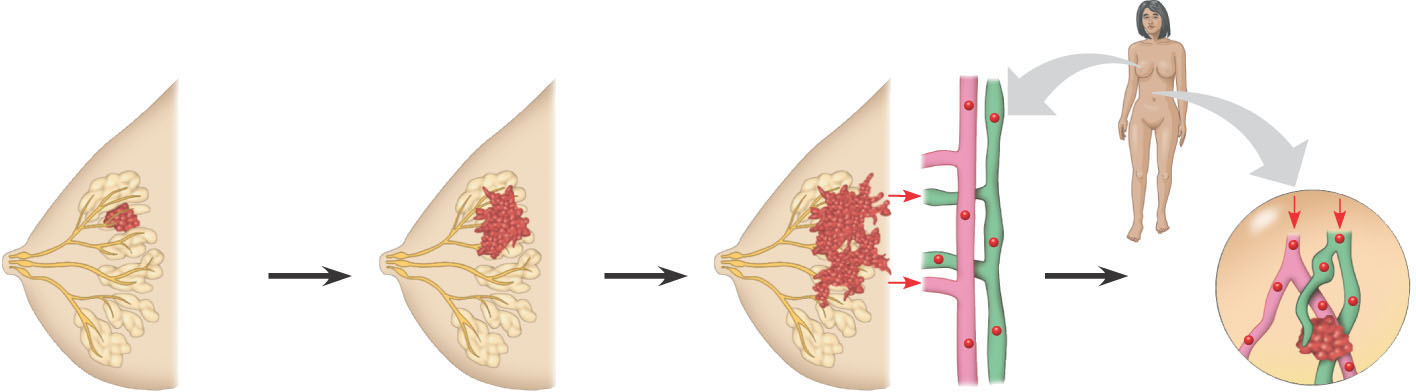 Solusyklin kontrollin menetys: Syöpäsolut Pahanlaatuisen rintasyövän kasvu ja metastasis Tumor Lymph vessel Glandular tissue Cancer cell Blood vessel Metastatic Tumor Kasvaimen kasvu alkaa yhdestä