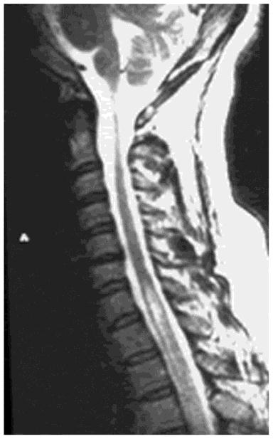 Spine MRI in a patient with delayed radiation myelopathy reveals swelling of the spinal cord in association with hyperintensity within the cord on the T2-weighted image.