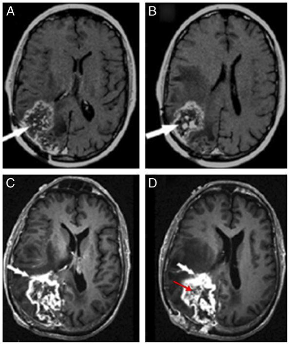 T1-enhanced MRI in right parietooccipital radiation necrosis shows an internal appearance of "Swiss cheese/soap bubble" enhancement (white arrow, A and B).