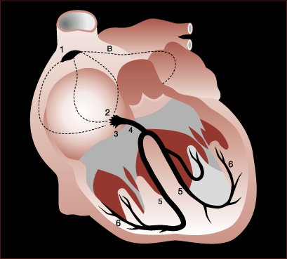 ja seuraavan supistuksen välillä on tietynpituinen aikaväli. Siksi sydänlihassupistukset ovat aina yksittäisiä. (Bjålie ym. 2007, 228.) Kuva 1. Sydämen johtoratajärjestelmän osat.