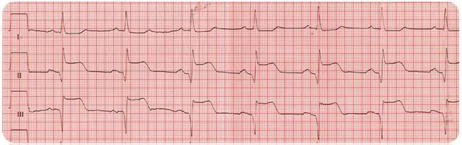 21 iskemian aiheuttaa sepelvaltimon ahtautuminen. EKG:n avulla voidaan selvittää vaurion laajuutta, paikkaa ja kehitystä. (Heikkilä 2003, 254;