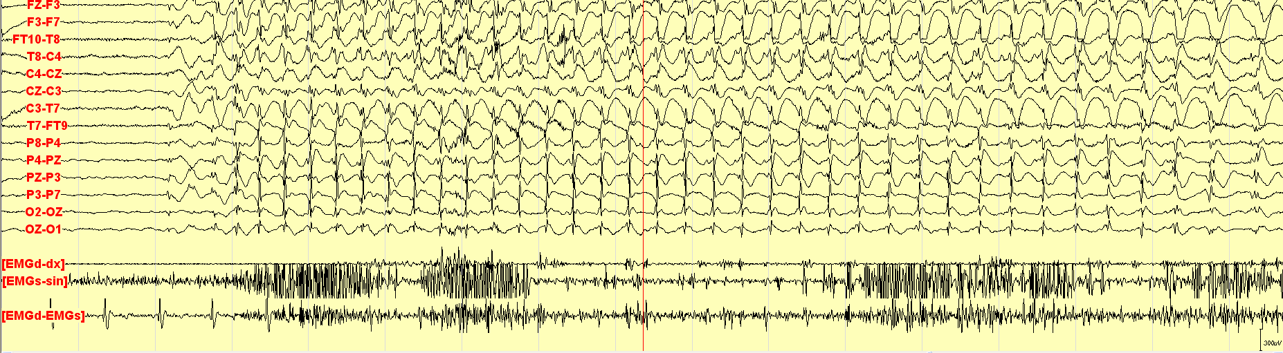 EEG: yleistynyt