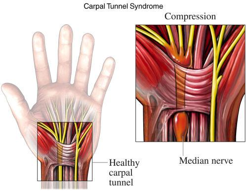18 (carpal tunnel syndrome) jonka voi aiheuttaa esimerkiksi kudosturvotus rannekanavan alueella tai toistuva ranteen koukistajalihasten kuormitus (kuva 5).