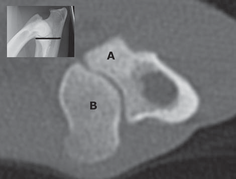 Kuva 3. Tietokonetomografiakuva englanninsetterin terveestä kyynärnivelestä. B. Pitkittäisleikkaus samasta nivelestä. 3 A. Poikkileikkaus pikkukuvan osoittamasta tasosta.
