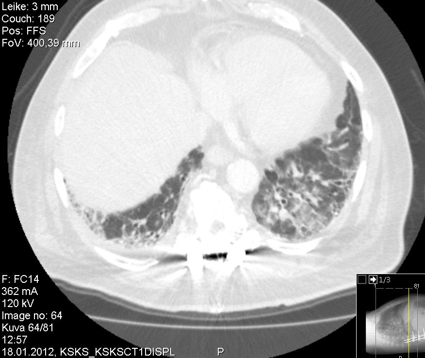Embolia-CT 1/2012 Lähetteen pohjalta HRCT 9/2014
