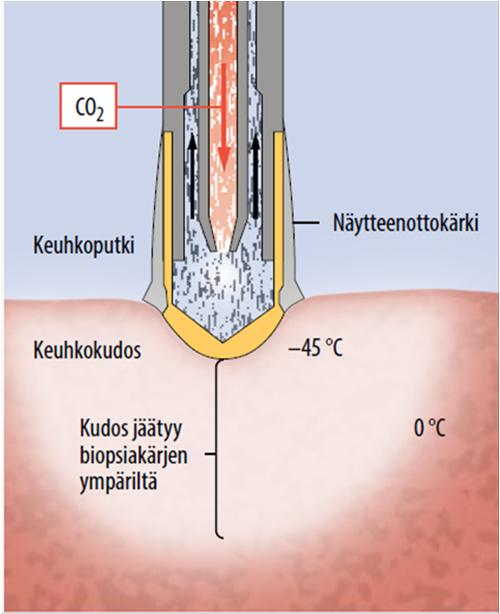 Kryobiopsia Lääketieteellinen Aikakauskirja