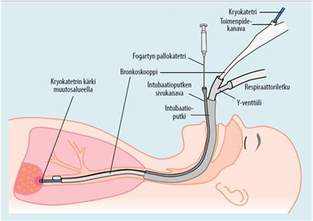 Systeeminen skleroosi SLE Asbestoosi