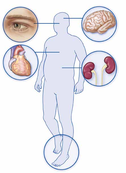 Vakavien lisäsairauksien riski Pitkäaikainen korkea verensokeri saattaa vaurioittaa verisuonia ja hermoja Tällöin mm.