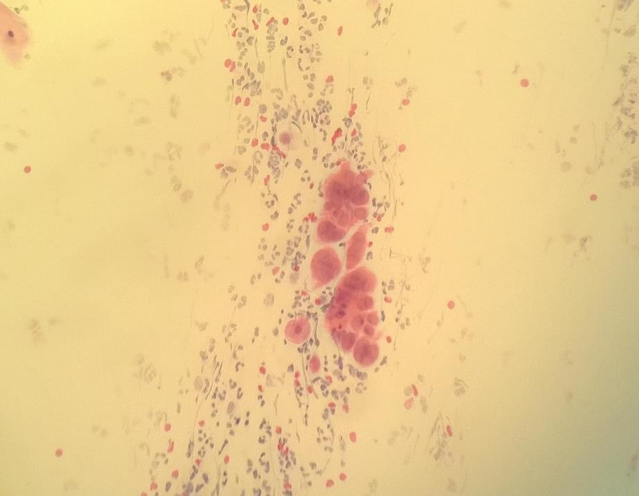 13 Ihmisen herpesvirustyypeistä sukuelinherpestä aiheuttaa yleisimmin Herpes simplex virustyyppi 2 (HSV-2).