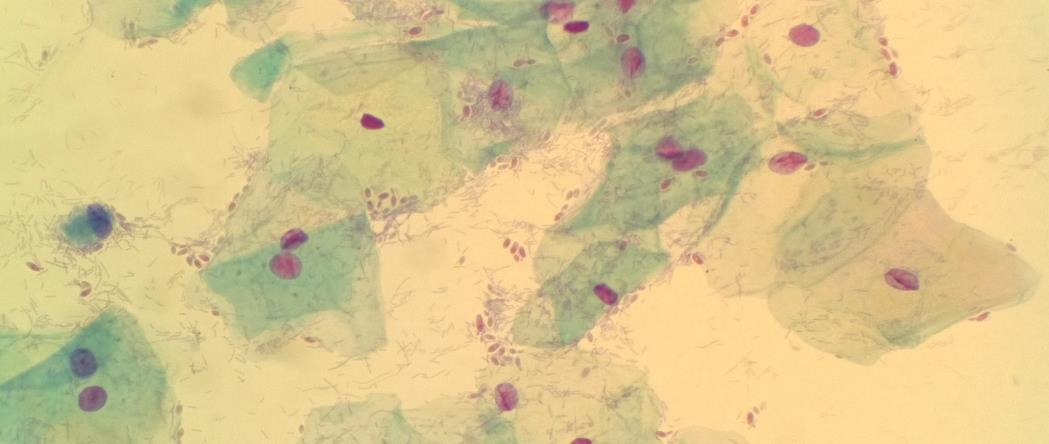 15 5.5.6 Hiiva Emättimen hiivasienitulehduksen aiheuttajana on useimmiten (85 90 %) Candida albicans, toisinaan myös Candida Glabrata.