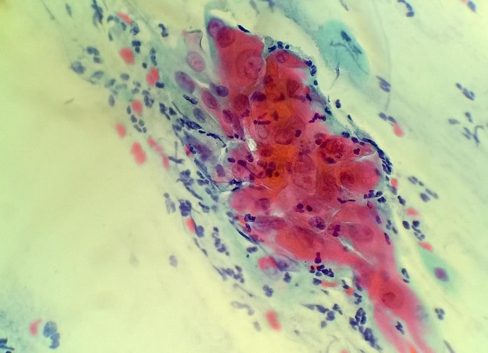 16 5.6 Reaktiiviset muutokset Gynekologisessa irtosolunäytteessä reaktiiviset muutokset luokitellaan yleisesti ei- epiteeliatypiaa ryhmään ja deskriptiivinen diagnoosi kuvaa muutoksen tarkemmin.