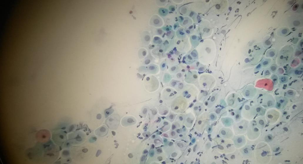 Ei-neoplastinen atrofia on hormonivaikutuksen vähenemisen seurausta, koska hormonin kudosravitsemusta ylläpitävä vaikutus vähenee.