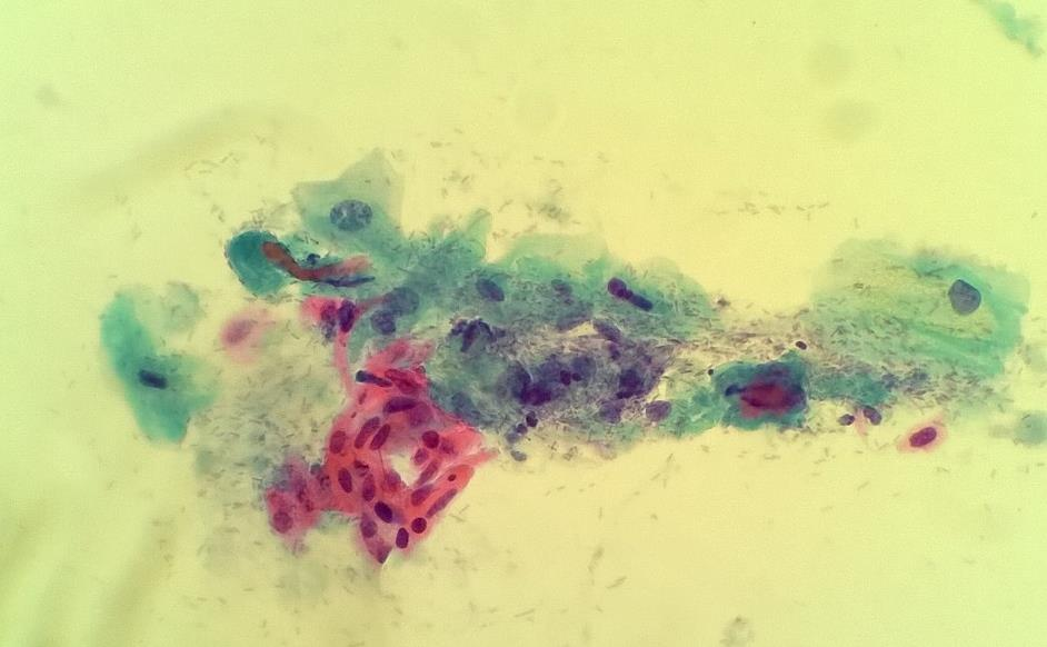 21 pioita on kuitenkin pyritty vähentämään ASC-US muutosta seurattaessa yli 35- vuotiaille tehtävällä korkean riskin HPV- testauksella. (Räisänen 2010.) 5.9.