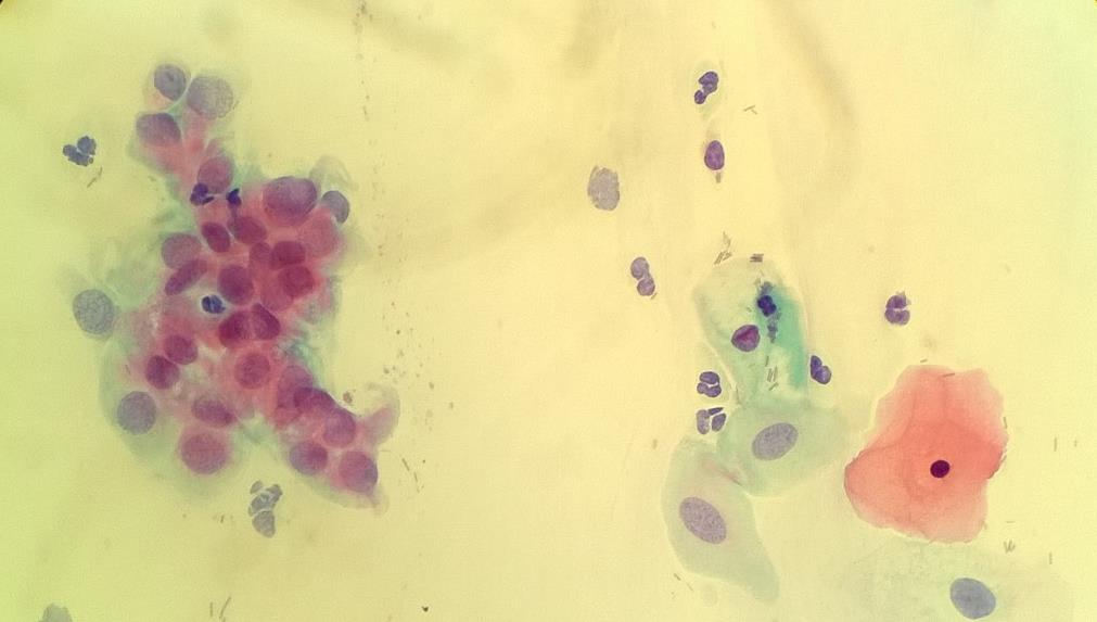 22 ASC-US, atyyppinen metaplasia (Savikko Räbinä 2016). 5.9.