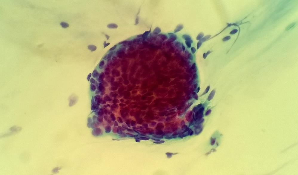 ASC-H (atypical squamous cells-high grade cannot be ruled out) levyepiteeliatypia muutoksessa HSIL (High grade squamous intraepithelial lesion) -muutosta ei voida