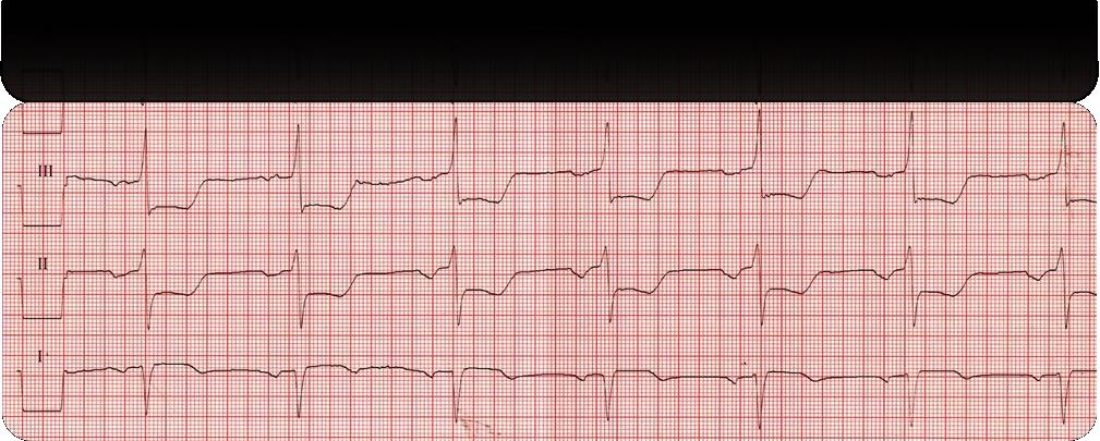 1 aina 2 usein 3 harvoin 4 en koskaan koska/jos: 28) Mikä EKG-löydös on alla olevassa V1- EKG-kytkennässä?