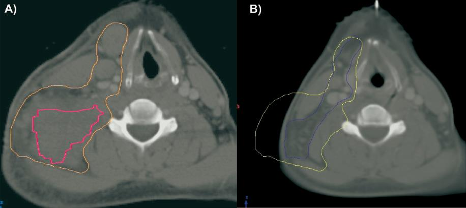 INRT Girinsky 2007 Semin Radiat Oncol A: oranssi alkuperäinen tuumorialue ja pinkki PET-positiivinen tuumori