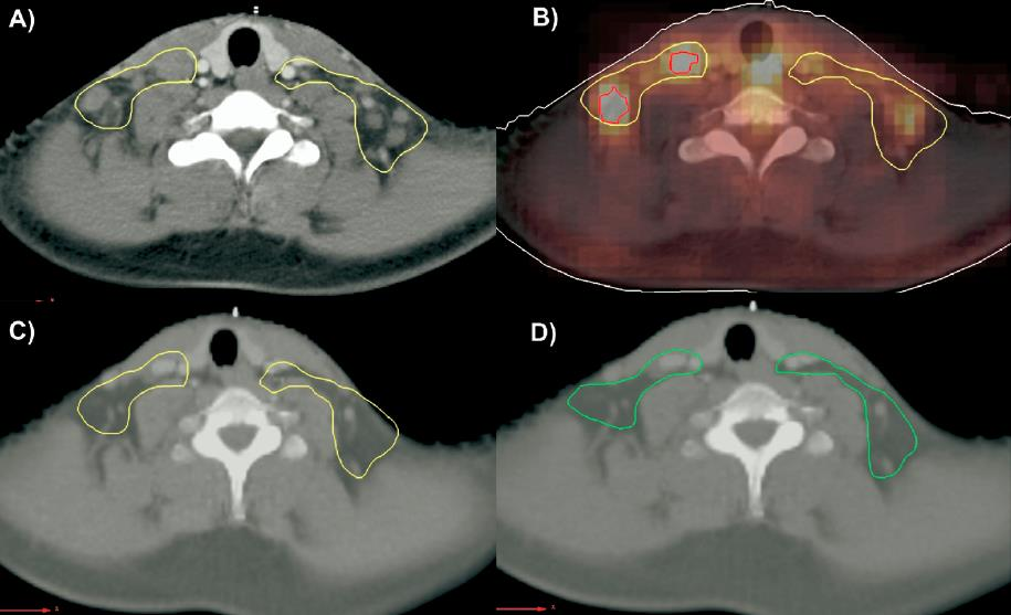 Girinsky 2007 Semin Radiat Oncol A: keltainen alkuperäinen tuumorialue prekemo TT:ssä, B: punainen PET-positiivinen