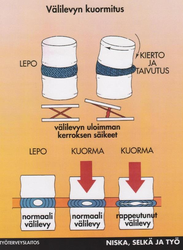 Kiertävässä liikkeessä selkärangan välilevyt ovat huonossa asennossa, eivätkä tue optimaalisesti (KUVA 2.) (Hakimo 2015, viitattu 16.12.2015).