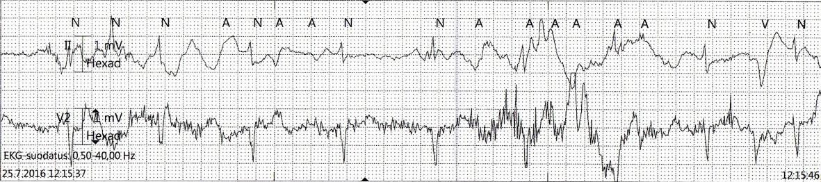 21 KUVA 5. Lihasjännityshäiriö ja perustason vaellushäiriö (Kuva: Mika Huuhtanen 2016) Vaihtovirtahäiriö (kuva 6) näkyy EKG:ssa säännöllisenä sahalaitakuviona 50 Hz:n taajuudella.