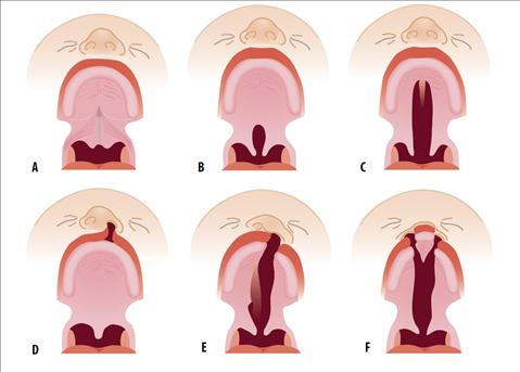 23 6.2 Halkiovauvojen imettäminen Huuli- ja suulakihalkiot ovat huulen ja kitalaen alueella esiintyviä epämuodostumia (Kere 1998, 26; Page-Goertz & Riordan 2005, 563 ).
