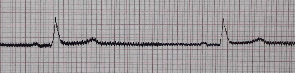 Häiriö voi syntyä myös kahdesta toisistaan riippumattomasta tekijästä, kuten esimerkiksi ihonkäsittelyn laiminlyönnistä ja asiakkaan jännityksestä. Tällainen EKG-käyrä on lähes tulkintakelvoton.