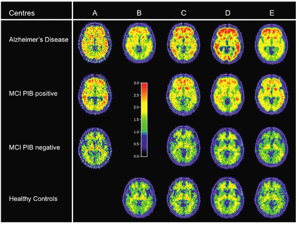 III Neurologisiin sairauksiin ja oireyhtymiin liittyvät kognitiiviset oirekuvat Kuva 2.
