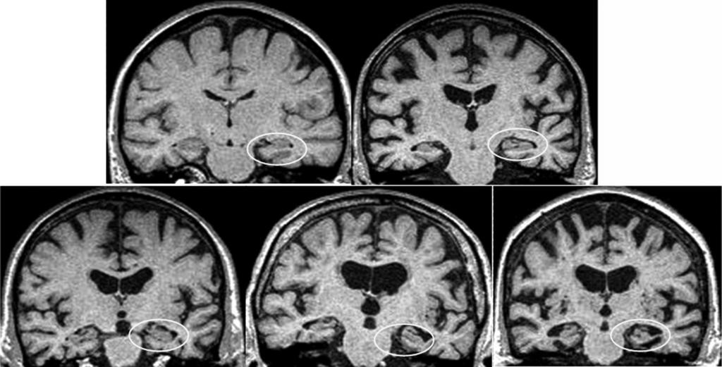 III Neurologisiin sairauksiin ja oireyhtymiin liittyvät kognitiiviset oirekuvat Auguste D AT:n kuvasi ensimmäisenä saksalainen lääkäri Alois Alzheimer.