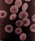 HbA1c Mitä tarkoittaa: mittaa sokeristuneen hemoglobiinin määrää punasoluissa (= glykohemoglobiini) Mitä korkeampi verensokeri sitä enemmän