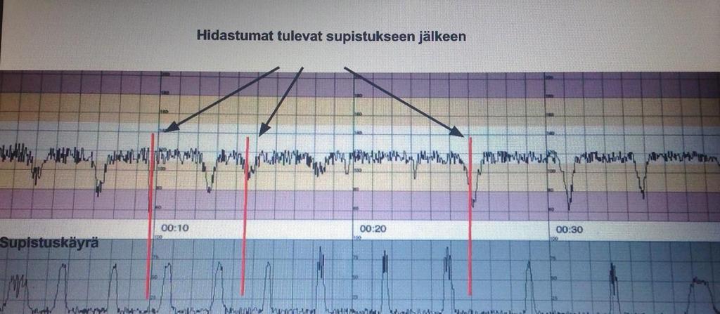 17 ottaa kapillaariverinäyte sen hetkisen hapetuksen tilan arvioimiseksi. (Keski-Nisula 2000.) 4.3.7 Myöhäiset hidastumat Tyypillistä myöhäisille hidastumille on niiden säännöllinen kuvio.