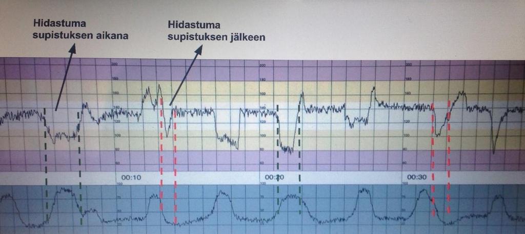 18 tetään usein napanuora komplikaatioon, sitä kutsutaan napanuorakuvioksi. (Uotila 2015: 530.) Kuvio 7.