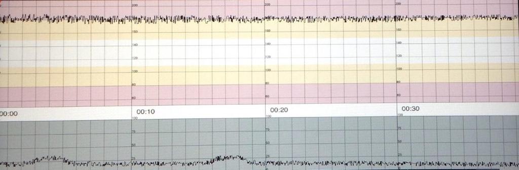 21 dosinusoidaalista käyrää sinusoidaalisesta. Käyrän kuvion lyhytkestoisuus onkin tärkein kriteeri erottaa nämä kaksi toisistaan. (Ayres-de-Campos ym. 2015: 20.) 4.3.