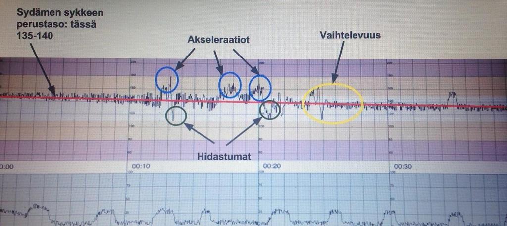 24 4.4.1 Normaali KTG Sikiön sykkeen normaali perustaso on 110-160 lyöntiä minuutissa.