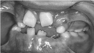 kleidokraniaalinen dysplasia) luun hypoplasia