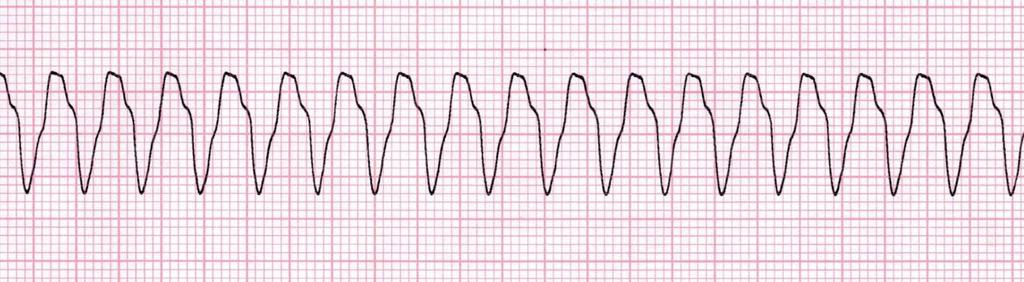9 trokardiogrammi, sydänsähkökäyrä) piirtyvä epätasainen käyrä johtuu sähköisen toiminnan