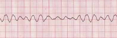10 SR eli Sinus rhythm eli Sinusrytmi Sinusrytmi on sydämen luonnollinen sähköinen rytmi. Sydän tahdistuu normaalisti sinussolmukkeesta. Verenkierto on normaali. (Kuisma ym.