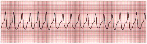 Pulseles Electrical Activaty eli Pulssiton monitorirytmi ASY eli Asystole eli Asystolia Kammiovärinässä sydämen sähköinen johtuminen on täydellisessä kaaoksessa eikä sydän kykene kierrättämään verta.