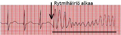 2015, 259 260; Thaler 2012, 138) Kammiotakykardiassa sydämen sähköinen tahdistuminen alkaa kammiosta ja on tyypillisesti nopea yli 140 kertaa minuutissa.