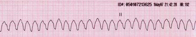 a) Kammiovärinä b) Kammiotakykardia c) Sinusrytmi d) Asystole 21.