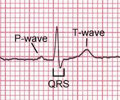 EKG:N OSAT - REPOLARISAATIO Depolarisaatiota seuraavan supistumisen jälkeen kammiot latautuvat eli seuraa repolarisaatio