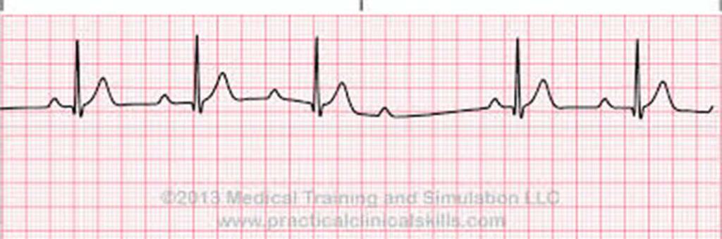 P-AALLOT Löytyykö? (jos ei FA? SVT? VT?) Seuraako jokaista QRS-kompleksi?