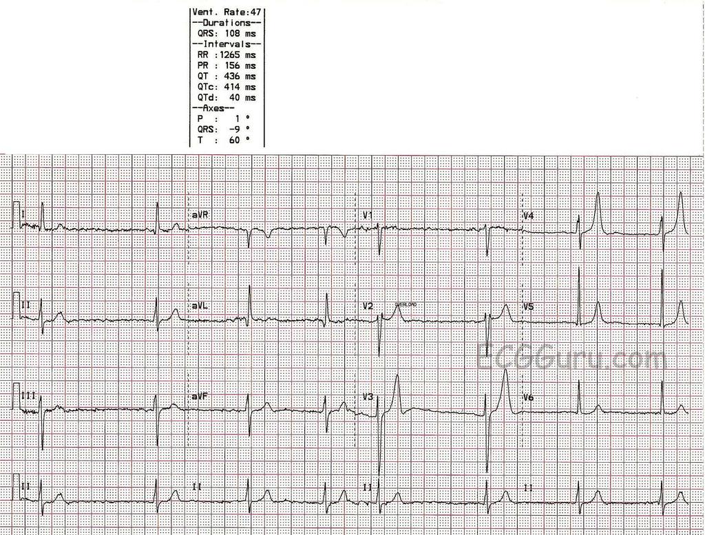 ST-VÄLI Laskut = iskemiaa (Vai peilikuvamuutokset?) Nousut = infarkti (anatomisesti oikeat alueet!