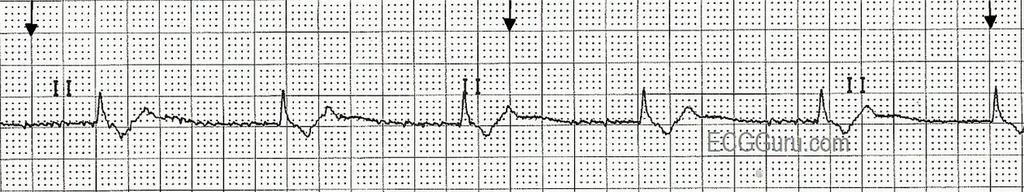 BRADYKARDIA Bradykardia (hidaslyöntisyys) voi liittyä lisääntyneeseen vagaaliseen tonukseen, lääkitykseen, sinussolmukkeen häiriöön tai sydäninfarktiin Matala syke on ongelma vain jos