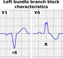 VASEN HAARAKATKOS (LBBB) 21/4/17