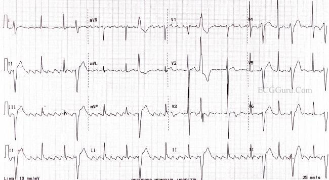 POTILASTAPAUS 2 (EKG) 21/4/17