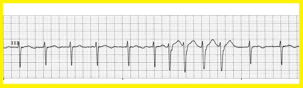 POTILASTAPAUS 8 (EKG) 21/4/17