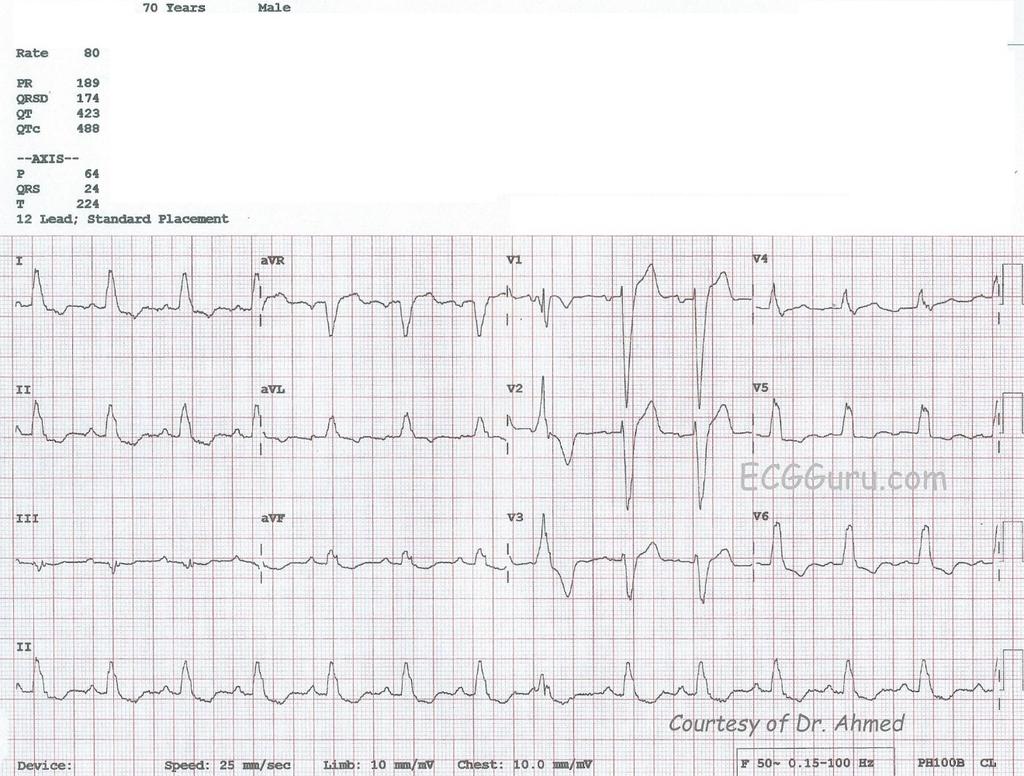 POTILATAPAUS 10 (EKG) 21/4/17