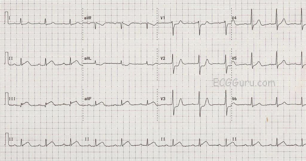 POTILASTAPAUS 14 (EKG) 21/4/17