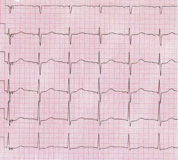 Kuva 1. Rasitus-EKG:n ST-välin tulkinta (36). Tärkeimmät ST-välin muutostyypit ja esimerkki lievistä ST-välin muutoksista (alle 1 mm), jotka eivät liity sepelvaltimotautiin.