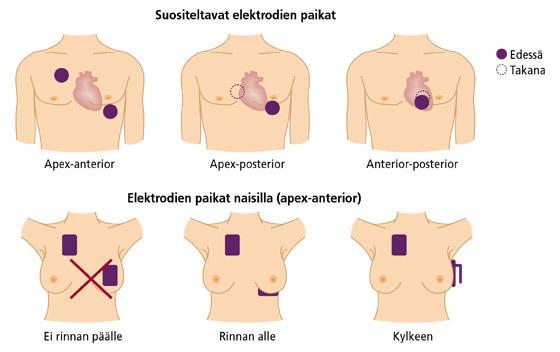 30 KUVA 2. Defibrillaatioelektrodit asetetaan siten, että sydän jää elektrodien väliin, jolloin sähkövirta kulkeutuu sydämen läpi (Huikuri & Raatikainen 2008, 544).